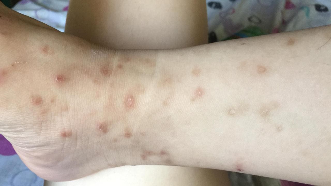 How to get rid of mosquito bite scars