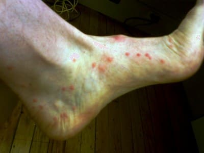 Ankle biter mosquito bites - Swollen ankle after mosquito bite