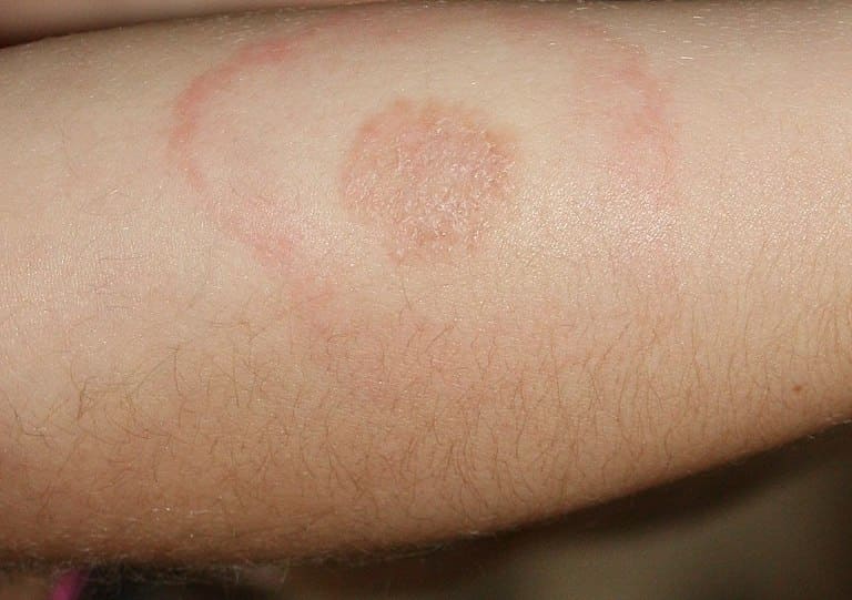 Lyme Disease rash caused by Tick bite