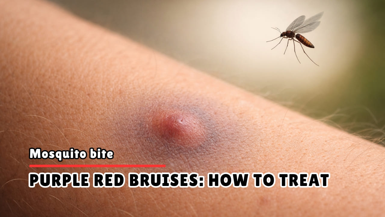 Bruising Around Mosquito Bite - Causes & Treatment