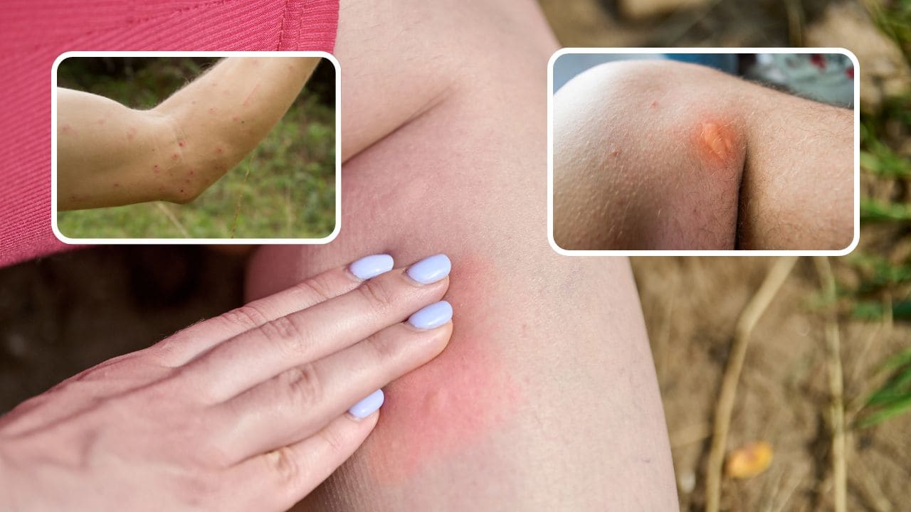 How Do You Know If a Mosquito Bite Is Infected